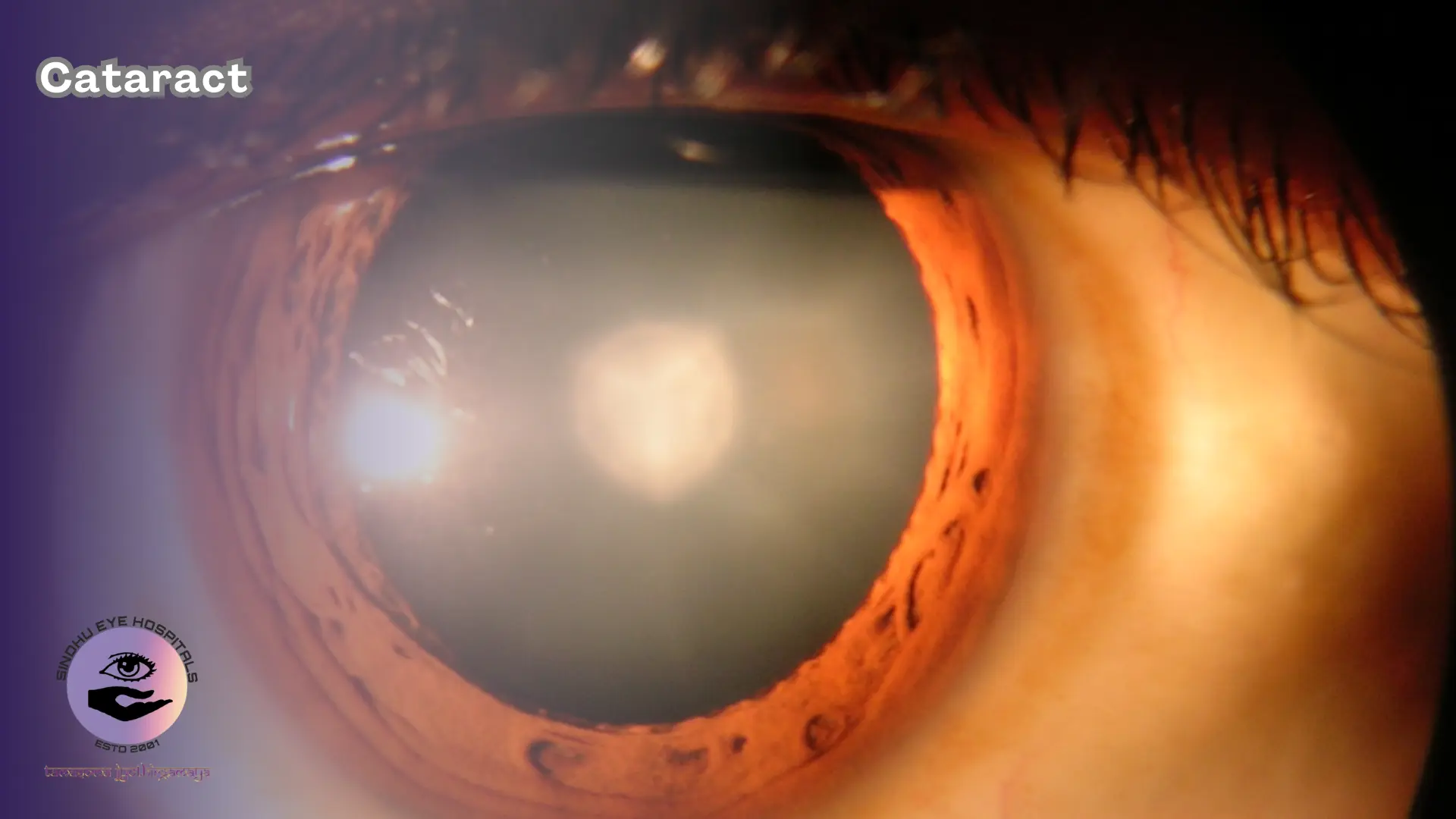 Cataract Services